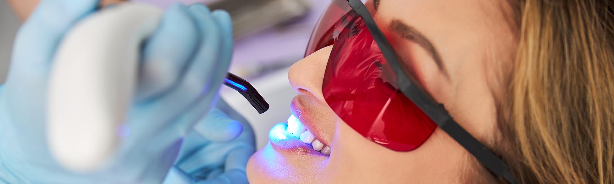  Professional Teeth Whitening vs. Over the Counter: Which Is Best?