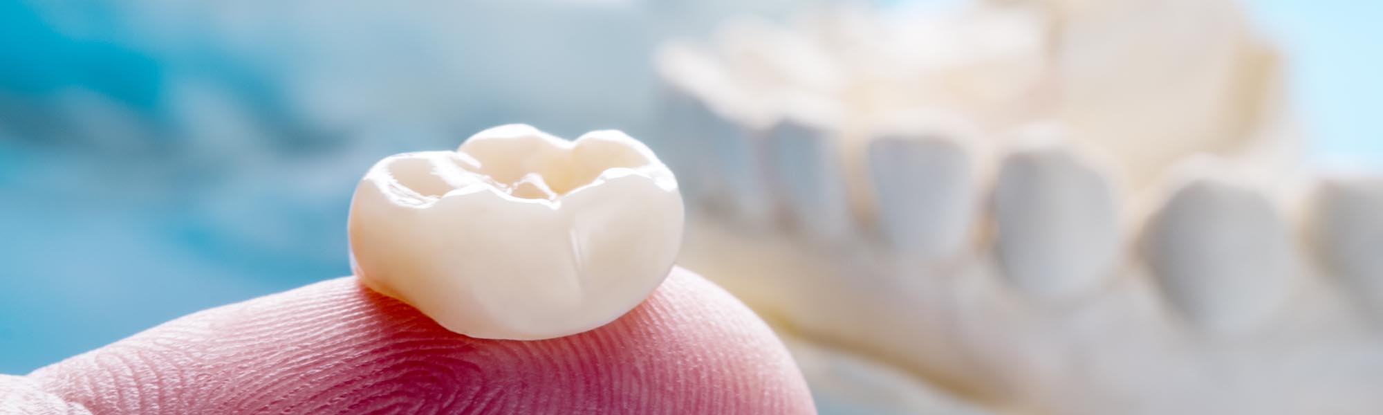   When Should I Consider a Dental Crown?